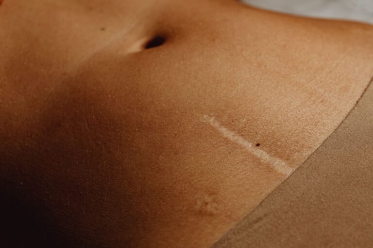 Apron Belly: How to Tackle It Without Surgery