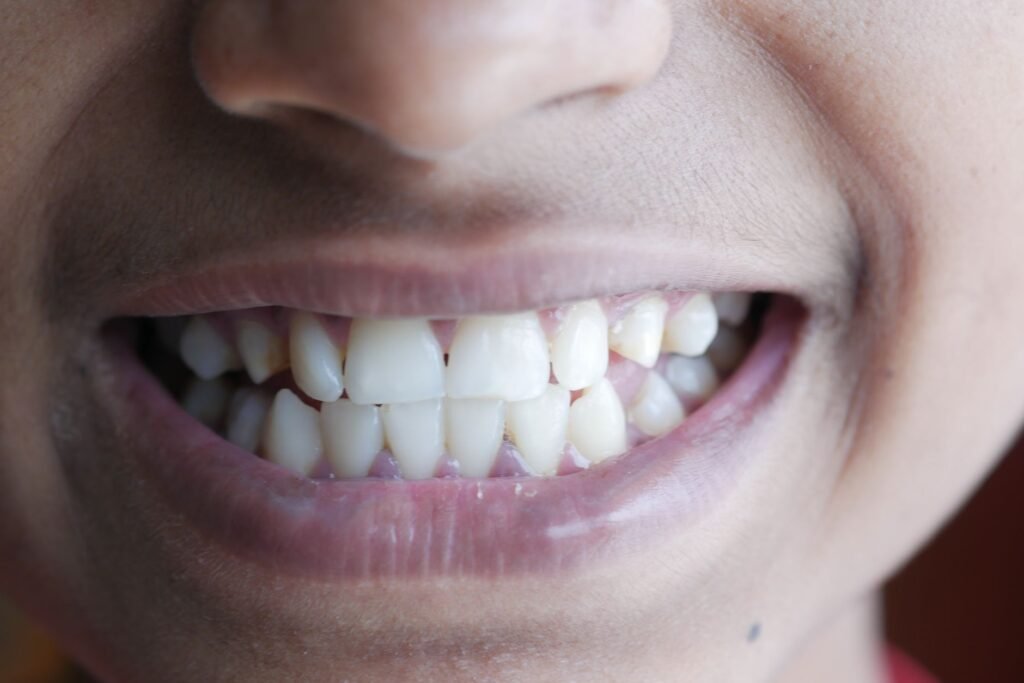 Buck Teeth: Fix or Embrace Them?