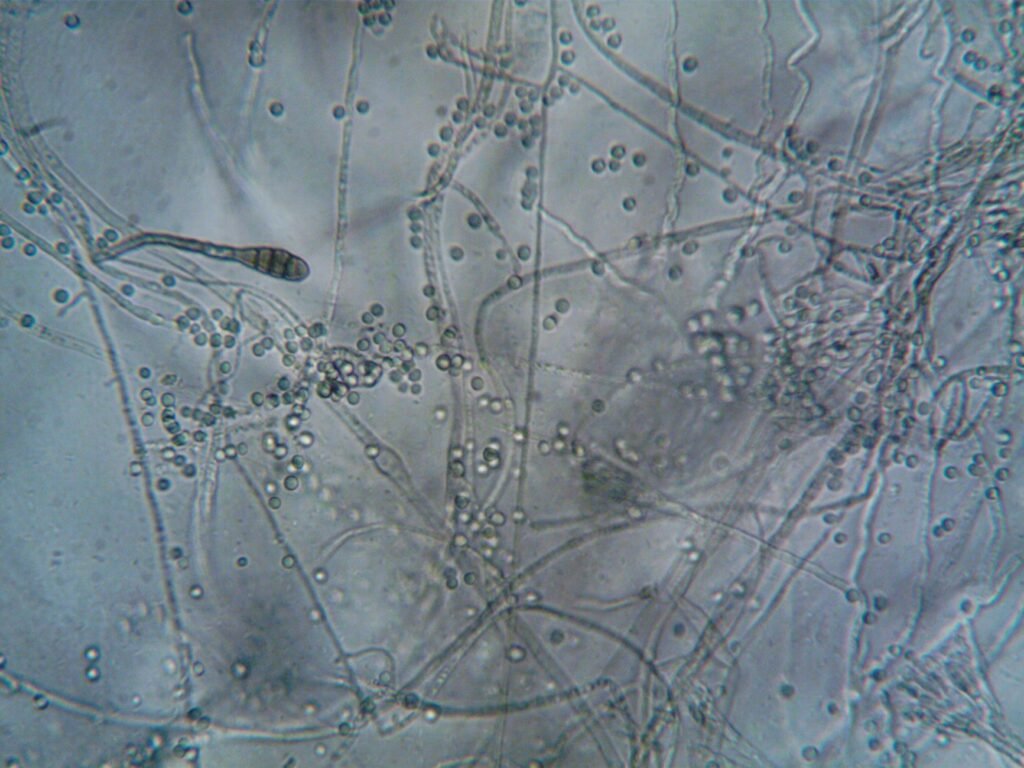 Fungal Kidney Infection: Rare Risks Exposed