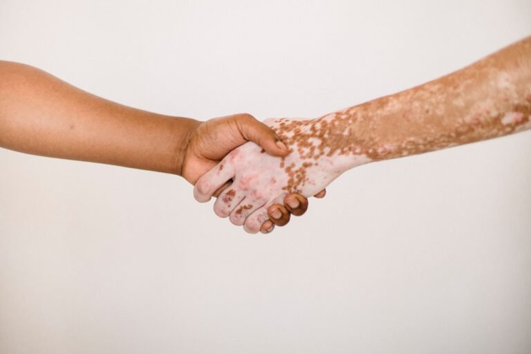 Nail Psoriasis vs Fungus: Spot the Difference