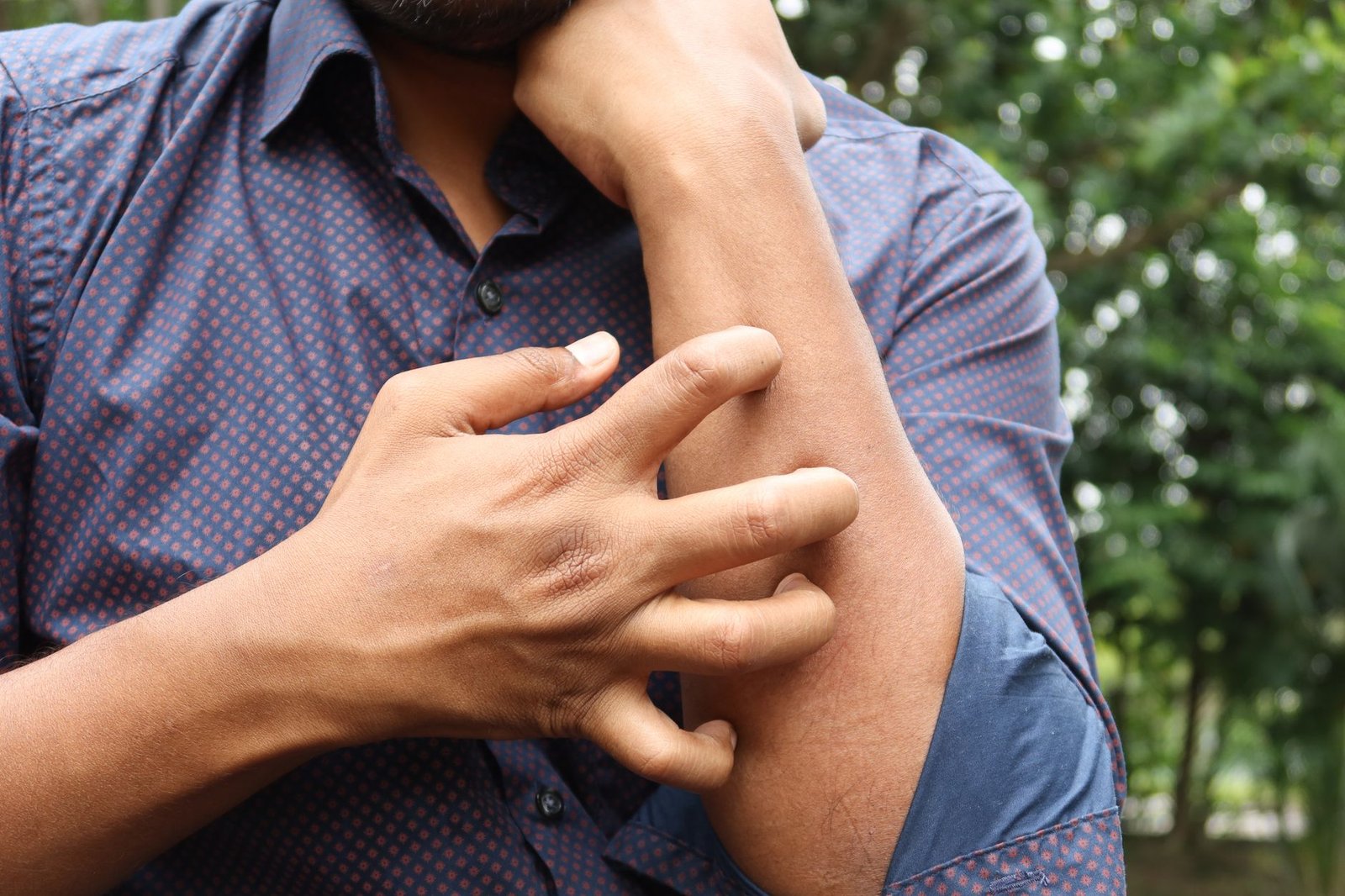 Spongiotic Dermatitis: Clear Your Skin