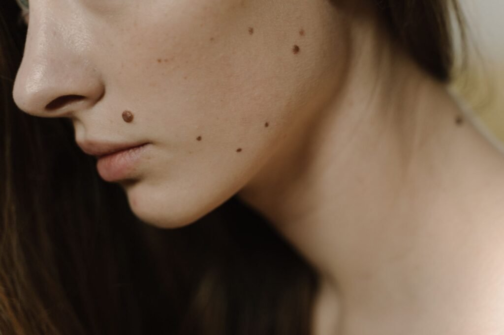 Mole Removal Infection Signs
