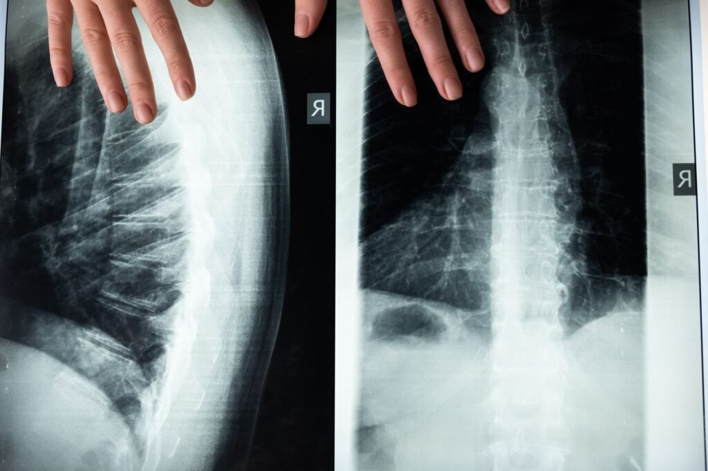 Spinal Infection