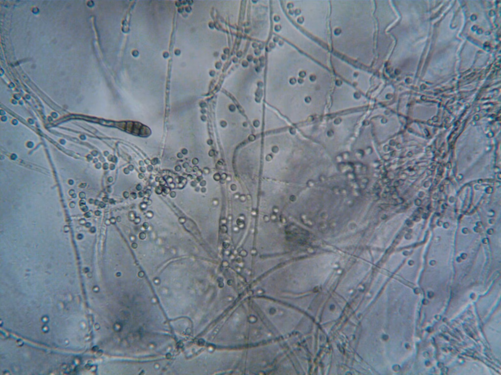 Yeast Infection Vestibular Papillomatosis