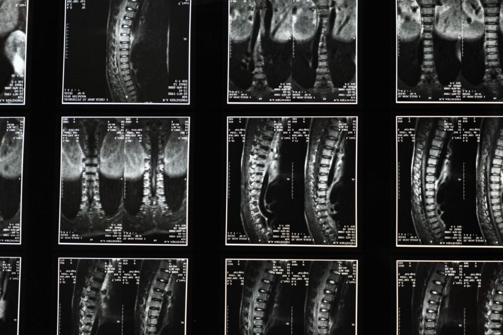 A clear illustration of the lumbar spine showing vertebrae and discs