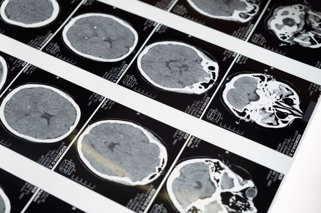 A clear MRI image illustrating the brain structures examined when diagnosing intracranial hypertension