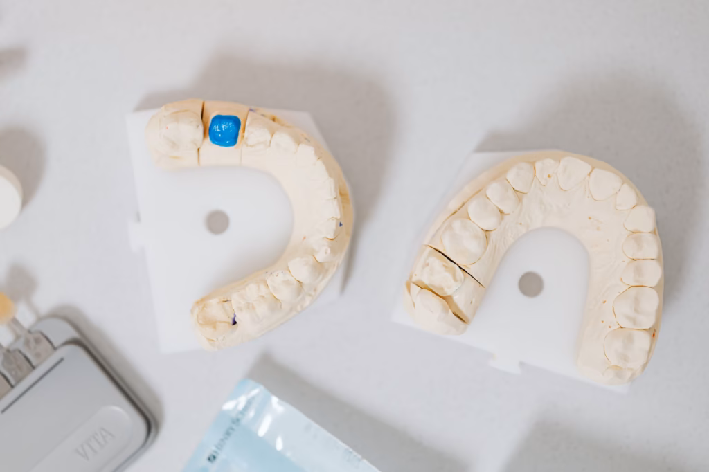 A close-up of a dental crown showing the margin where plaque can collect